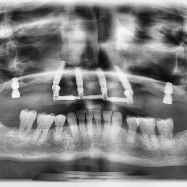 IMPLANTOLOGIA_MM_VISITA