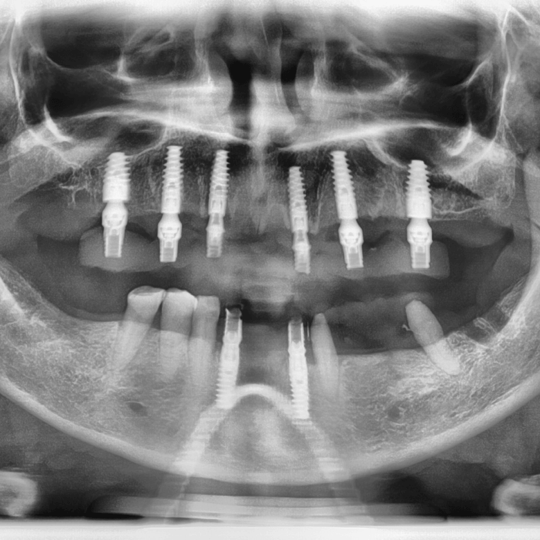 IMPLANTOLOGIA_PB VISITA